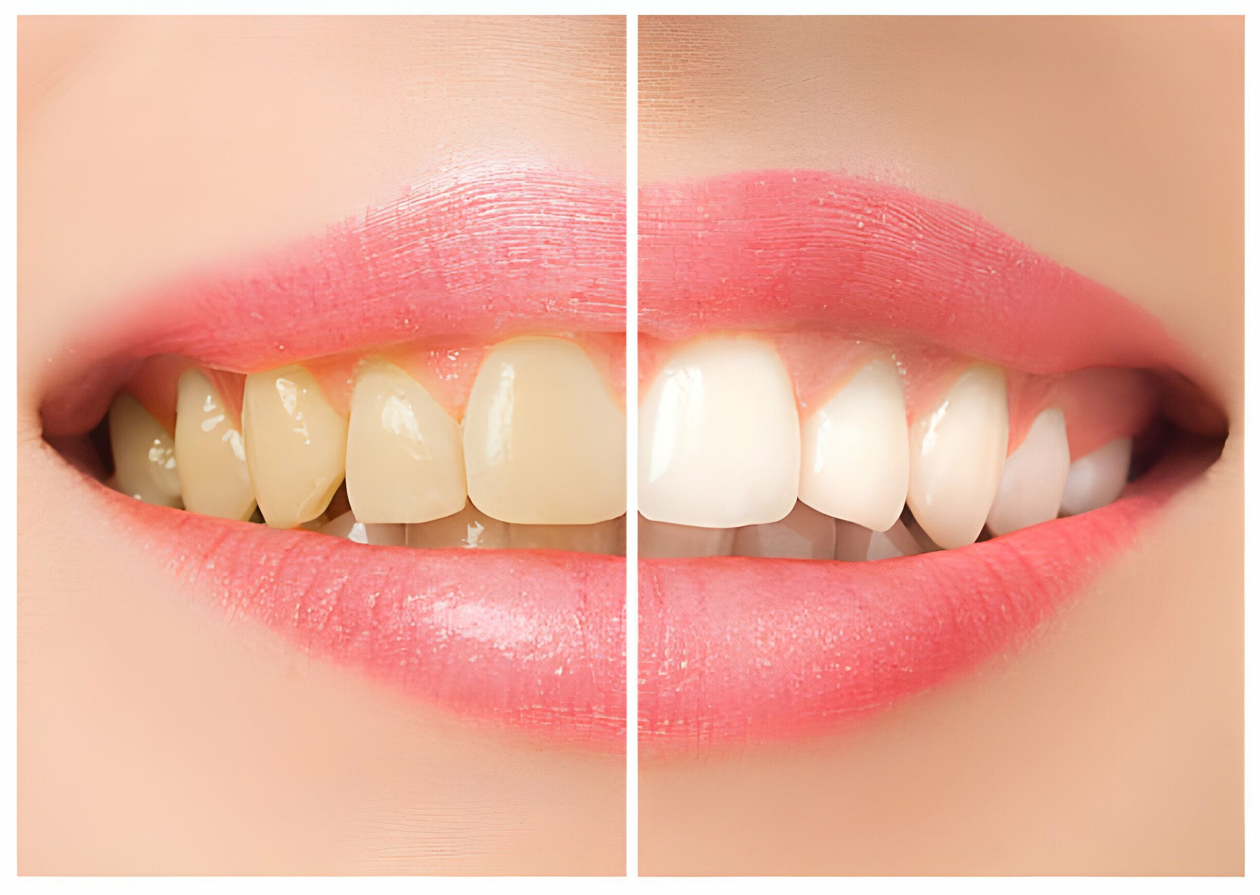 Teeth Whitening Explained: Complete Guide, Tips, Benefits & Key Insights